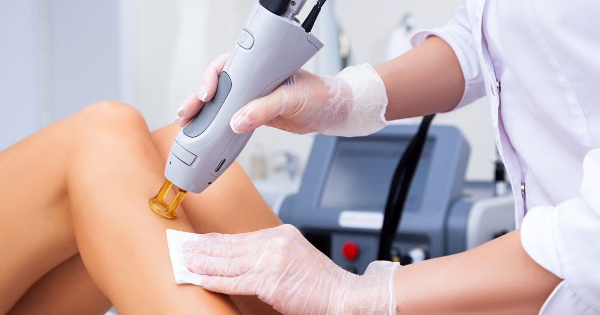 épilation au laser