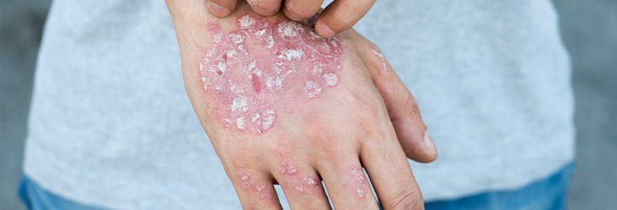 psoriasis